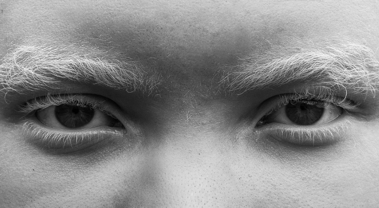 Albinism
